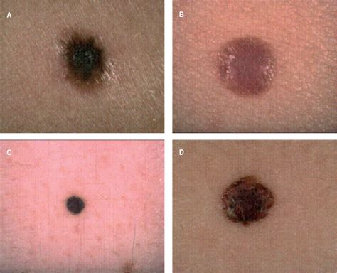 Small Nodular Melanoma: The Beginning of a Life-Threatening Lesion. A ...