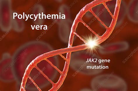 Polycythemia vera, illustration - Stock Image - F034/4326 - Science ...