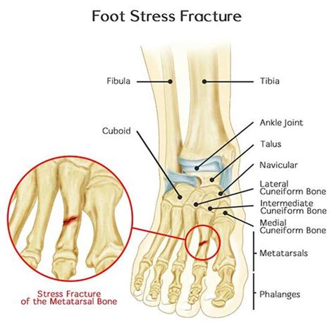 Foot Fracture Treatment Specialist · Manhattan Foot Specialists