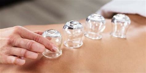 Qu'est-ce que la « thérapie par ventouses » ou « hijama