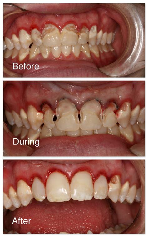 Tooth Cavity Filling Before And After