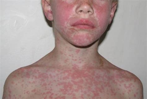 Mononucleosis Amoxicillin Rash - Https Www Amjmed Com Article S0002 ...