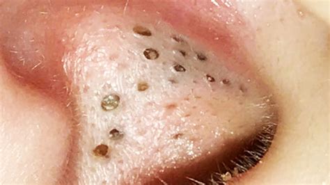 Pimple Popping 2025 Blackheads - Tommy Gretchen