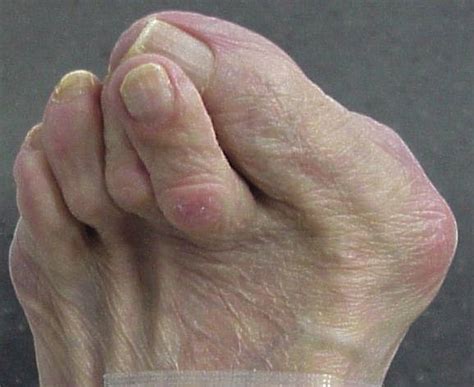 What To Expect From Hammertoe Surgery - Quality Foot Care