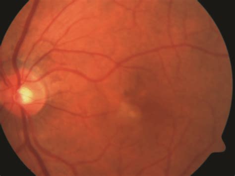 Choroidal Neovascularization