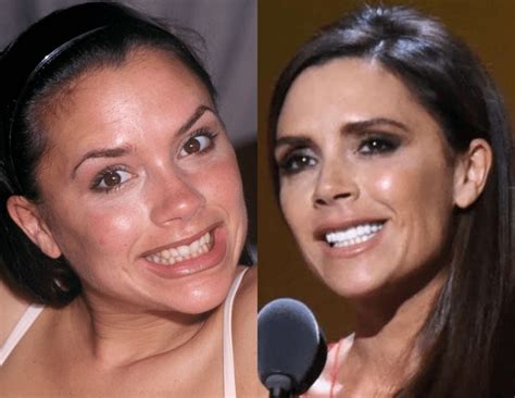 Celebs with the Most Dramatic Teeth Transformation | SmileBar