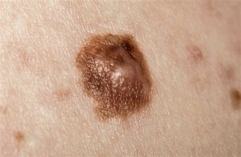 cancerous moles images | Symptoms and pictures