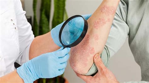 Psoriasis: Diagnosis, Treatment, Prevention, Diet and Medication ...