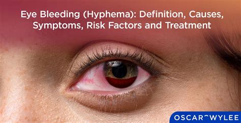 Eye Bleeding (Hyphema): Definition, Causes, Symptoms, Risk Factor and ...