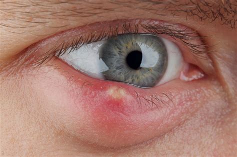 What is Chalazion? How is it treated? - Dr David Woo