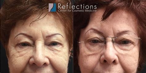 Exilis Ultra Non-Surgical Face Lift & Skin Tightening for Patient in ...