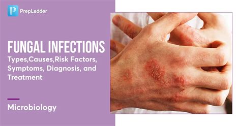 Fungal infections : Types, Causes, Risk Factors, Symptoms , Diagnosis ...