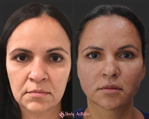 PDO Thread Lifting - Before and After Results at Skinly Aesthetics