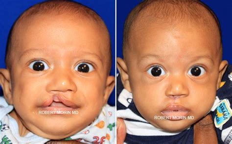 Cleft Lip And Palate Surgery, NJ | Dr. Robert Morin