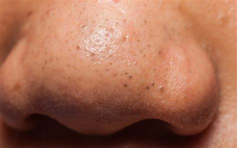 Blackheads on Nose: Causes, Remedies & Prevention Tips | The Derm Spot