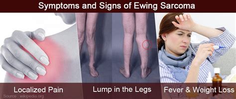 Ewing Sarcoma - Causes, Symptoms, Diagnosis, Prognosis & Treatment