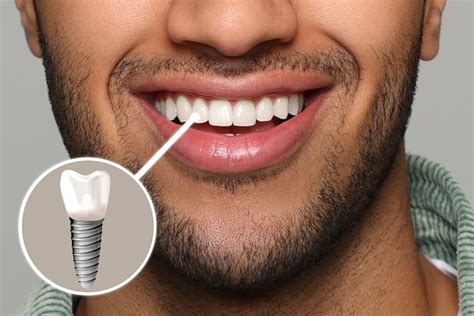 Tooth Replacement - The Steps for a Dental Implant Procedure - New York ...