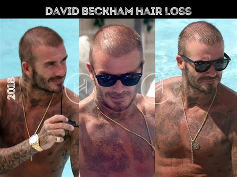 David Beckham Hair Transplant - Hair Loss & Technical Analysis