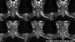 Dr Balaji Anvekar FRCR: Brachial plexitis MRI