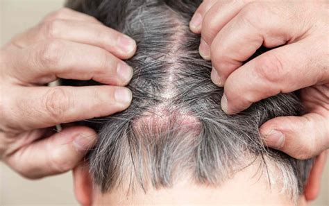 Scabs on Scalp: Causes, Diagnosis, and Treatment