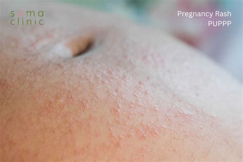 PUPPP: 7 Little-known Ways To Sooth Ypur Pregnancy Rash