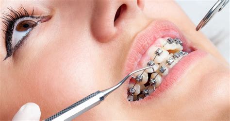 What are dental impressions for braces? | Musealesdetourouvre- A step ...