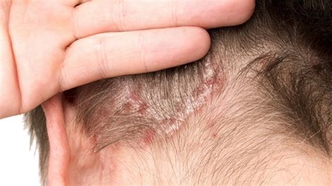 What Is Plaque Scalp Psoriasis Pictures Symptoms Photos Images | Images ...