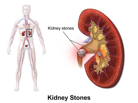 Kidney Stones Symptoms, Causes and Treatment