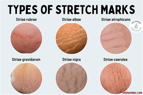 Types of Stretch Marks (with Pictures)