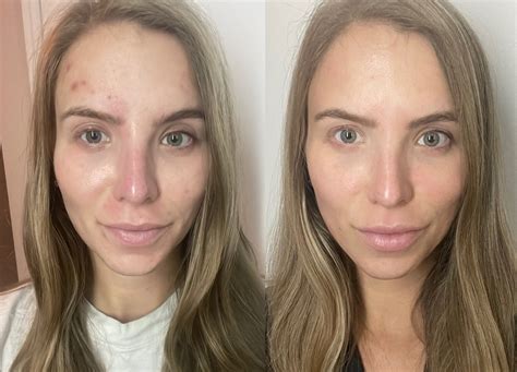 AviClear Laser for Acne: My Before and After Results | RealSelf News