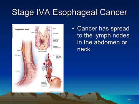 11 esophageal cancer