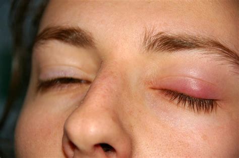 Chalazion – Symptoms, Causes, and Treatments - Fraser Valley Cataract ...