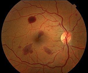 Fundus Imaging - Ophthalmic Photographers' Society