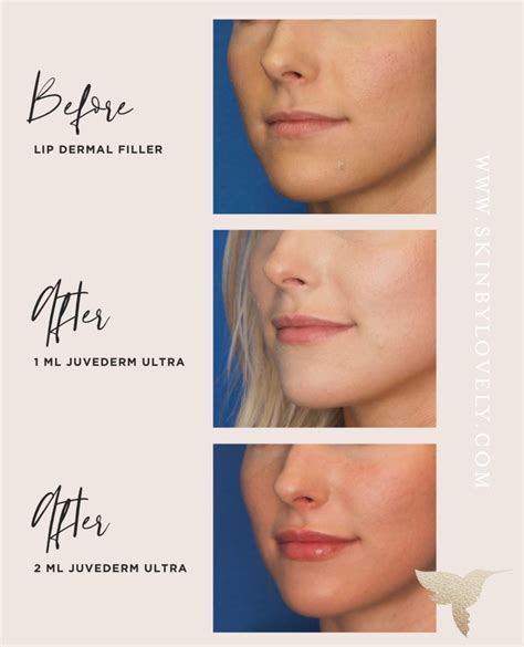 Lip Flip Botox Before And After Photos - Infoupdate.org