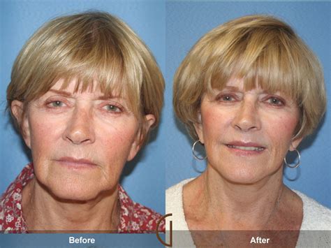 Before & After Facelift 55 | Facelift, Mini