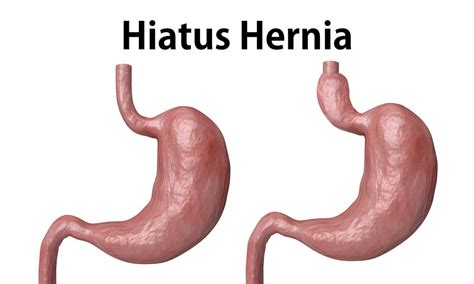 Hiatal Hernia : Overview, Causes, Symptoms, Treatment - illness.com