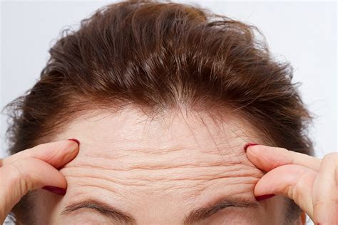 What Forehead Wrinkles Might Tell You About Your Heart Health | Live ...