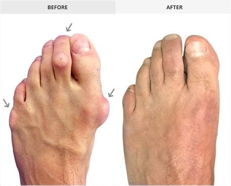 Tailors Bunion Surgery Scar