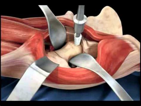 Arthroplasty Masterclass: Bipolar Hip Replacement | bipolar ...