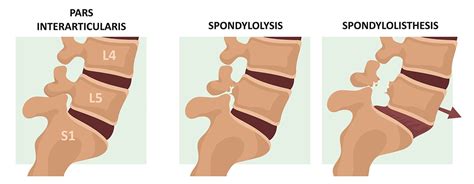 Do You Need Spondylolysis Surgery?