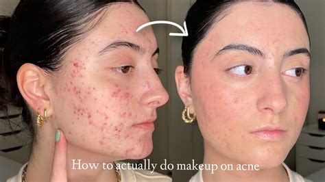 How To Apply Makeup To Dry Acne Skin | Saubhaya Makeup