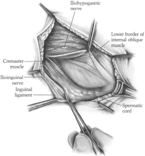 Iliopubic Tract Repair of Inguinal Hernia: the Anterior (Inguinal Canal ...