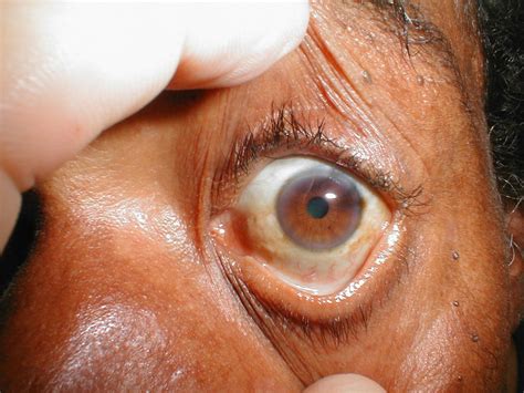 Sclera Disorders