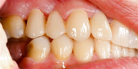 Gum Line Cavity – Symptoms, Cure And Treatment Methods - Zwivel