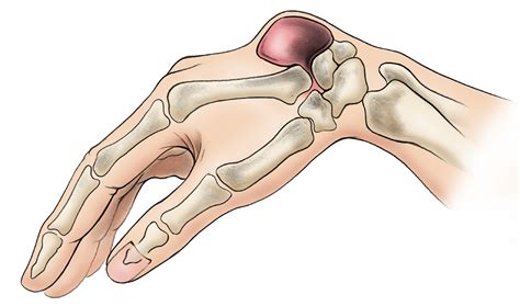 Ganglion Cyst of the Wrist and Hand - Mendelson Kornblum