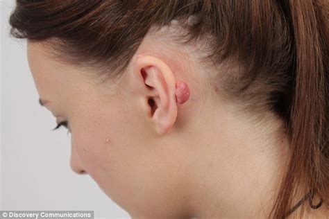 Student left with keloid scar after ear piercing as an act of teenage ...