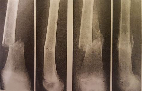 Pathology of Fractures and Fracture Healing - Momentum