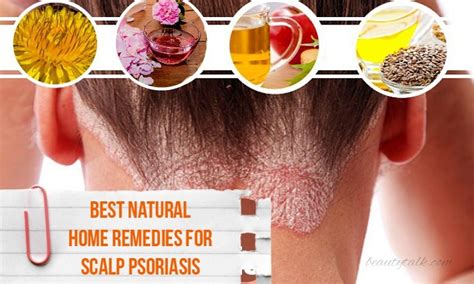 16 Best Natural Home Remedies For Scalp Psoriasis