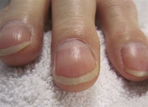 Nail Clubbing : Définition, causes et diagnostic