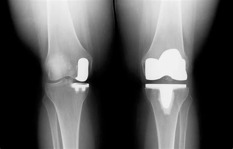 KNEE REPLACEMENT5 | Buyxraysonline